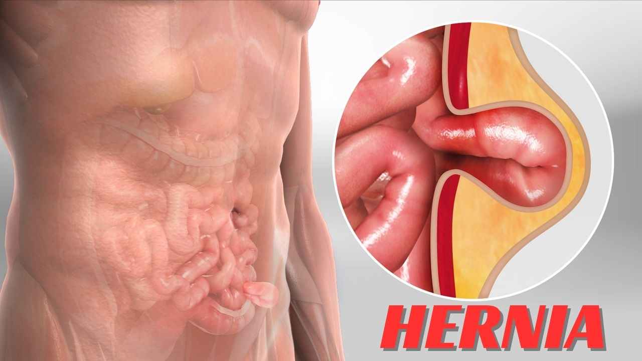 Hernia Full Details in Hindi